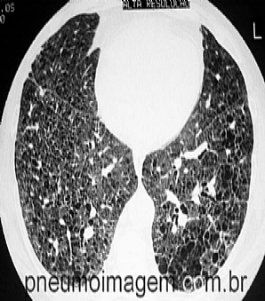 PIRFENIDONA PARA O TRATAMENTO DA FIBROSE PULMONAR IDIOPÁTICA PIRFENIDONA PARA O TRATAMENTO DA FIBROSE PULMONAR IDIOPÁTICA